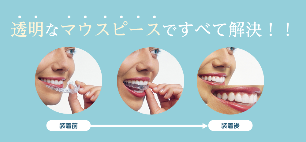 透明なマウスピースですべて解決します。